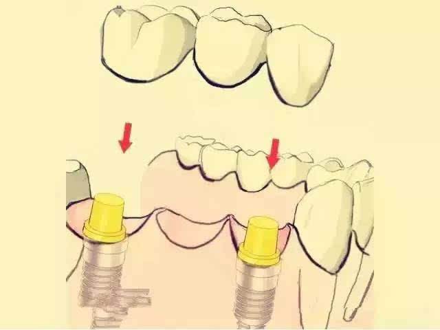 假牙种植牙.jpg