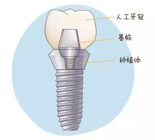 种植牙的优势体现在哪几个方面？