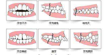 这10类牙齿畸形都能矫正