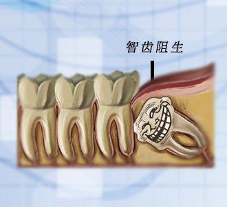 长有阻生齿要尽早拔除