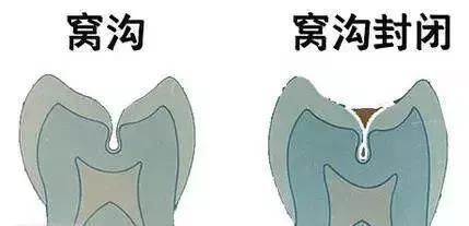 你的孩子有“窝沟龋”吗？
