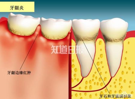 刷牙有血丝是否为牙周病的前兆？