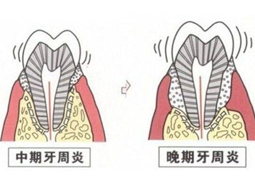 牙周病有什么症状呢？