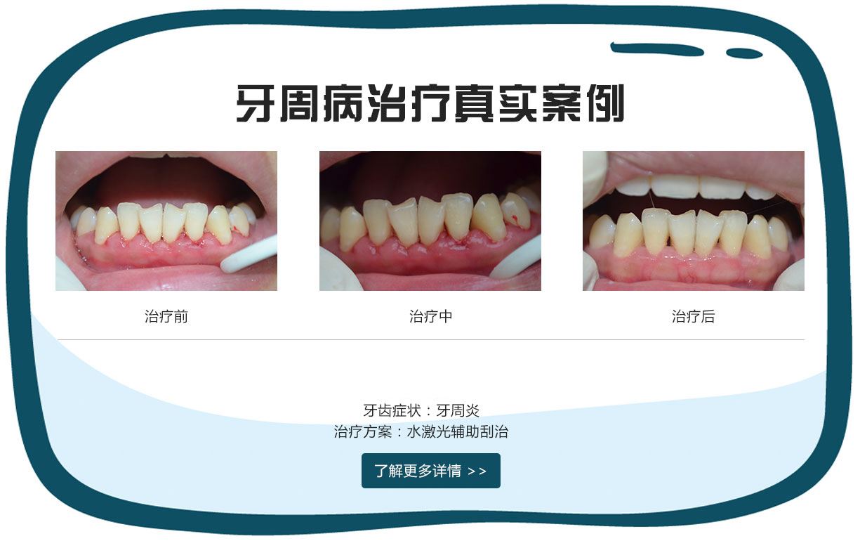 牙周病的症状、牙周病的诊断、预防及治疗