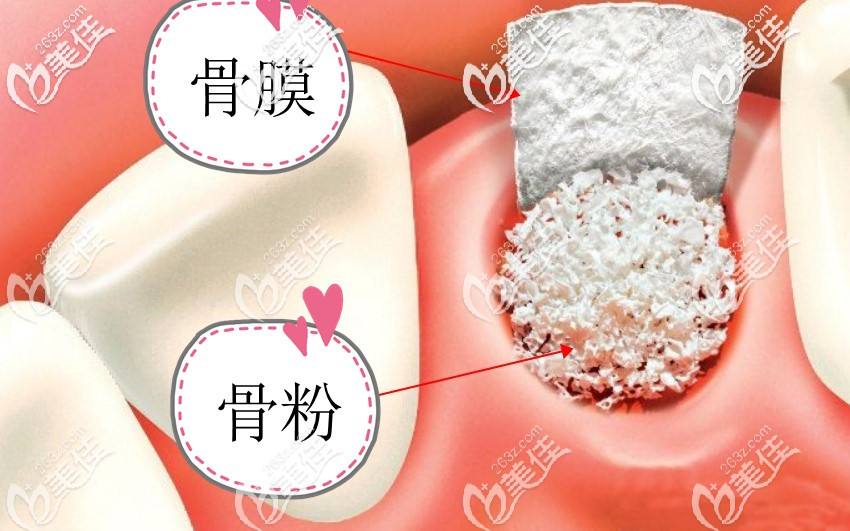 为何一些人拔智齿后需要补骨粉