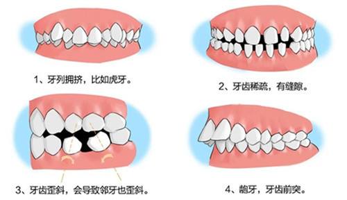 牙列不齐具有哪些危害