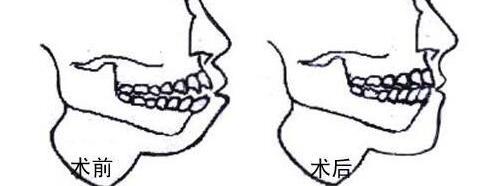 牙槽骨修复前需要做哪些处理