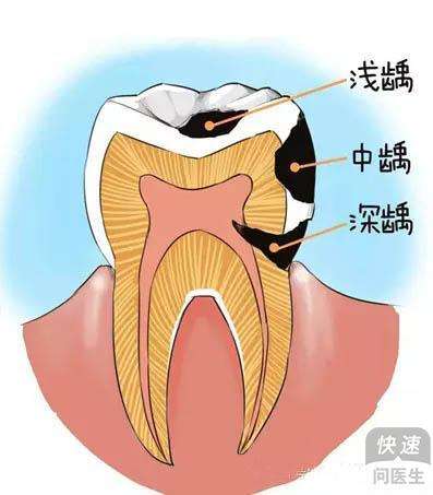 急性龋齿