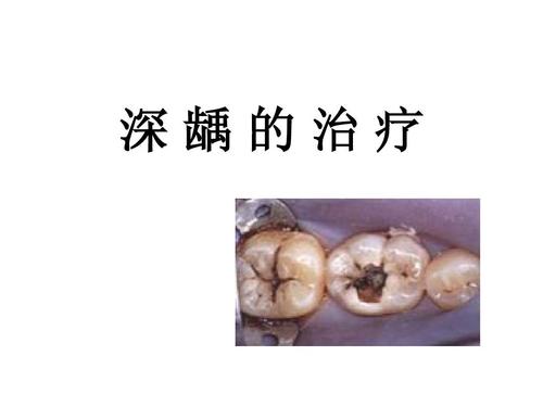 深龋的治疗措施是什么