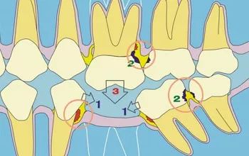 缺牙不尽早修复有哪些危害?
