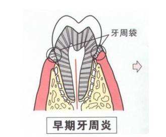 什么是牙周袋？