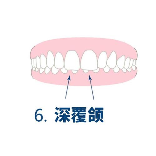 什么是牙颌畸形