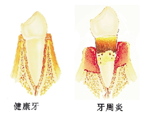 牙刷的好坏可以预防牙周病