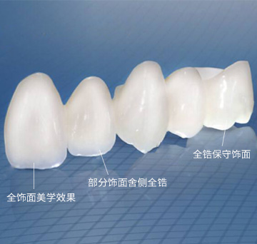 全瓷牙的优缺点介绍