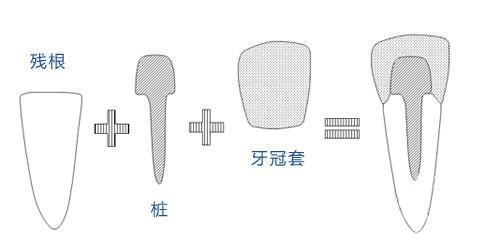 【福州】牙列缺损的修复方式