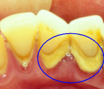 <b>口腔疾病如何预防？？？正确的清洁方法</b>