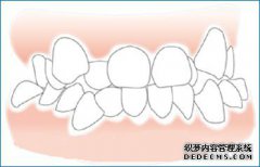 为什么会牙齿不齐
