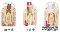 抽取牙神经会不会对牙齿有影响或是较不容易维