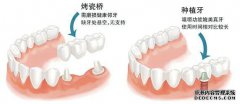 修复缺失牙，为何很多人青睐种植牙