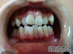 福州矫正牙齿哪里好？做矫正可以去小诊所吗？