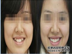 福州整牙齿会改变脸型吗？矫正牙齿都有哪些好