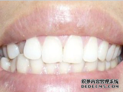 福州牙齿上下咬合不齐怎么矫正？都有哪些办法