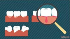 青少年患牙龈炎发病率近80%