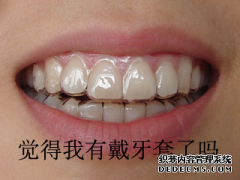 长乐牙齿矫正后会反弹吗？牙齿矫正后需要注意