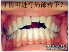 福州哪些牙齿可以做局部矫正？收费标准是怎样