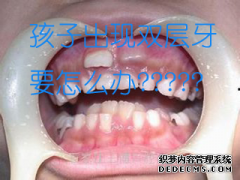 福州儿童长双层牙怎么办？小孩子几岁治疗比较