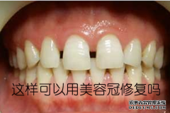 [福州门牙有缝怎么办，做美容冠怎么样？