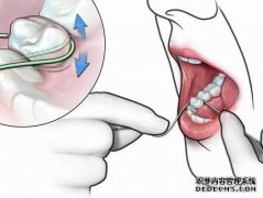 补牙后为什么会牙龈出血？