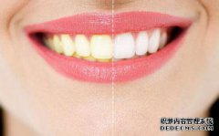 美白氟斑牙的费用高吗?