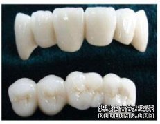 做美容冠的费用是多少？