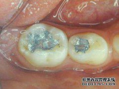大牙有龋齿修复需要多少钱?
