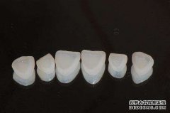 适合做瓷贴面的人群有哪些？