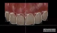 瓷贴面手术一般需要多长时间？