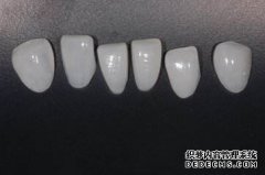 做瓷贴面需要多少钱？