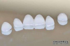 瓷贴面做完日常应该要如何进行护理工作？