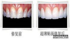瓷贴面的适应人群是哪些？