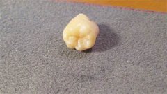 福州哪里拔智齿比较好？