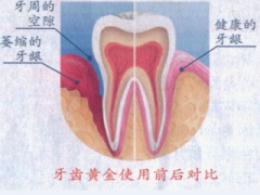 【福州】牙龈萎缩的那些事