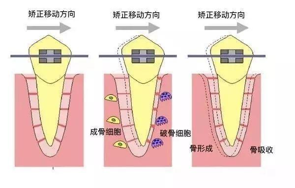 【福州】牙齿正畸治疗的原理是什么呢？