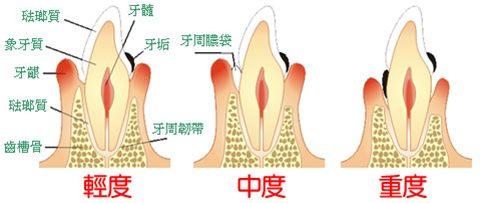 【福州】为什么每天刷牙还会得牙周炎？