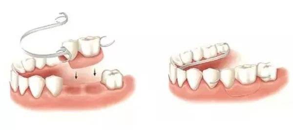 【福州】三种义齿修复方式对比