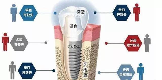 【福州】种植牙成功的先决条件