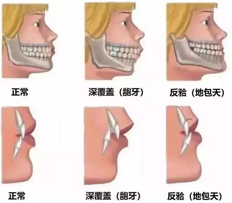 【福州】为什么会出现错颌畸形呢？